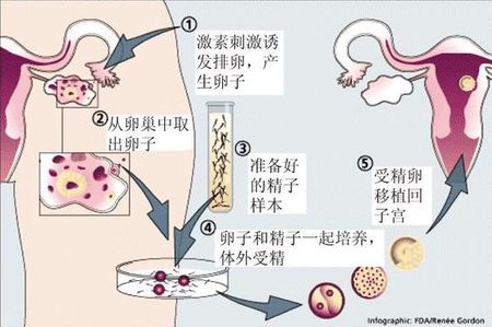 高龄二胎案例